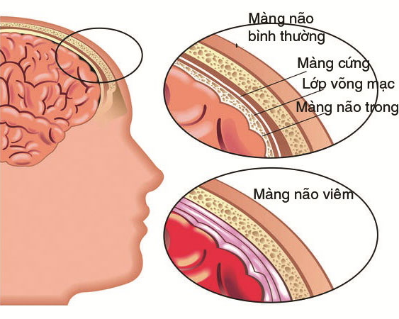 Ảnh 3 của Viêm màng não mô cầu